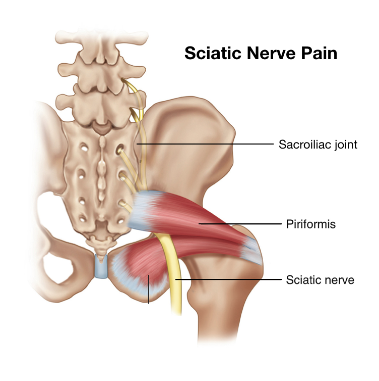 Sciatic-Nerve-Pain-SI-Piriformis-square