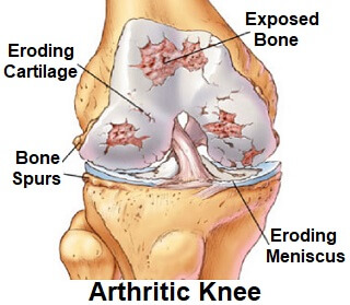 arthritis-in-the-knee